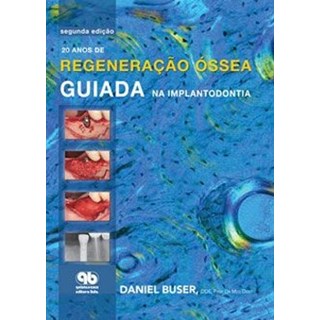 Livro - 20 anos de Regeneração Óssea Guiada na Implantodontia - Buser - Santos