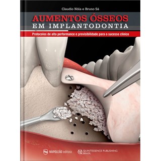 Livro - Aumentos Osseos em Implantodontia: Protocolos de Alta Perfomance e Previsiv - Noia/sa