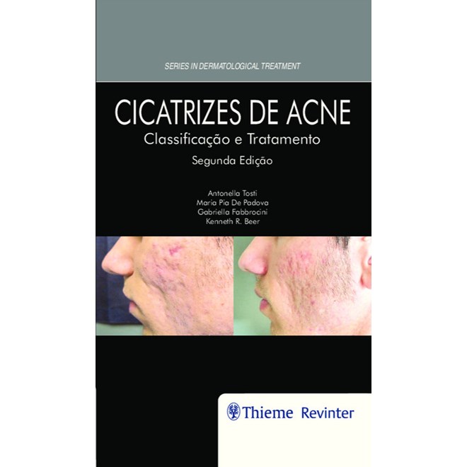 Livro - Cicatrizes de Acne Classificacao e Tratamento - Tosti/padova/fabbroc