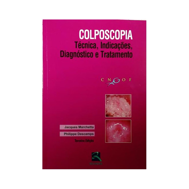 Livro - Colposcopia - Tecnica, Indicacoes, Diagnostico e Tratamento - Marchetta/descamps