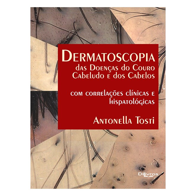 Livro Dermatoscopia das Doenças do Couro Cabeludo e dos Cabelos- Tosti
