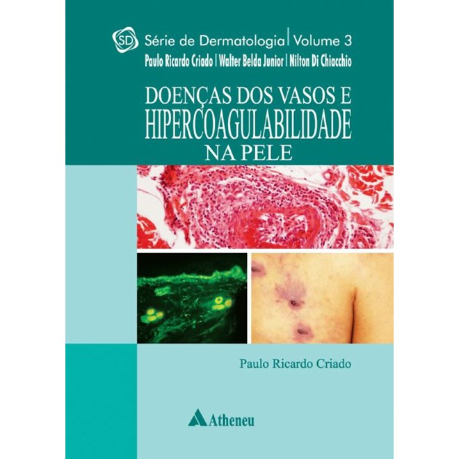 Livro - Doencas dos Vasos e Hipercoabilidade Na Pele - Vol.3 - Serie: Dermatologica - Criado