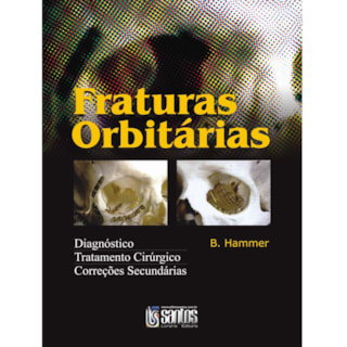 Livro - Fraturas Orbitárias - Hammer Livro - Fraturas Orbitárias - Hammer