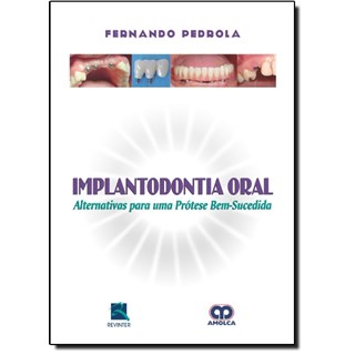 Livro - Implantodontia Oral - Alternativa para uma Prótese - Pedrola