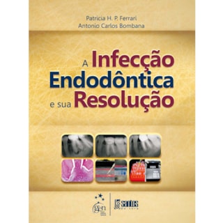 Livro - Infecção Endodôntica e sua Resolução, A - Ferrari Livro - Infecção Endodôntica e sua Resolução, A - Ferrari