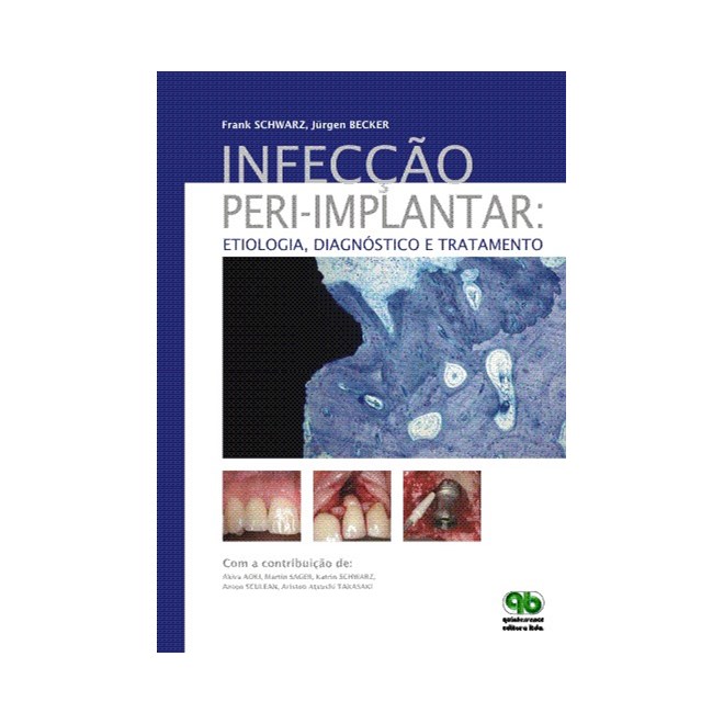 Livro - Infecção peri-implantar: Etiologia, Diagnóstico e Tratamento - Schwarz - Santos