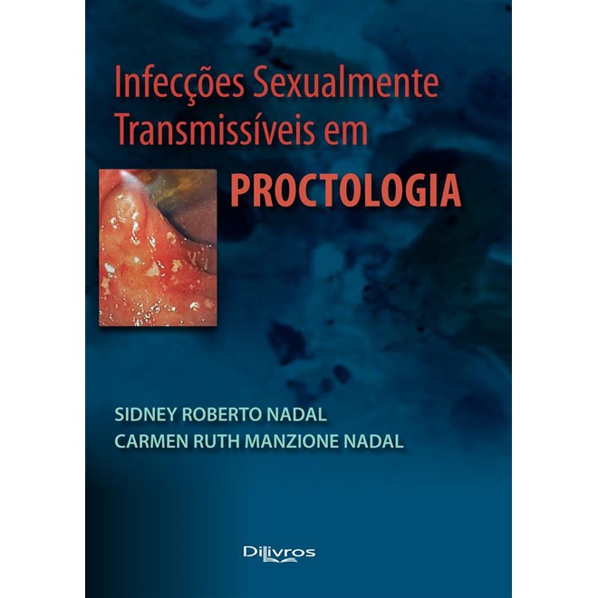 Livro - Infeccoes Sexualmente Transmissiveis em Proctologia - Nadal
