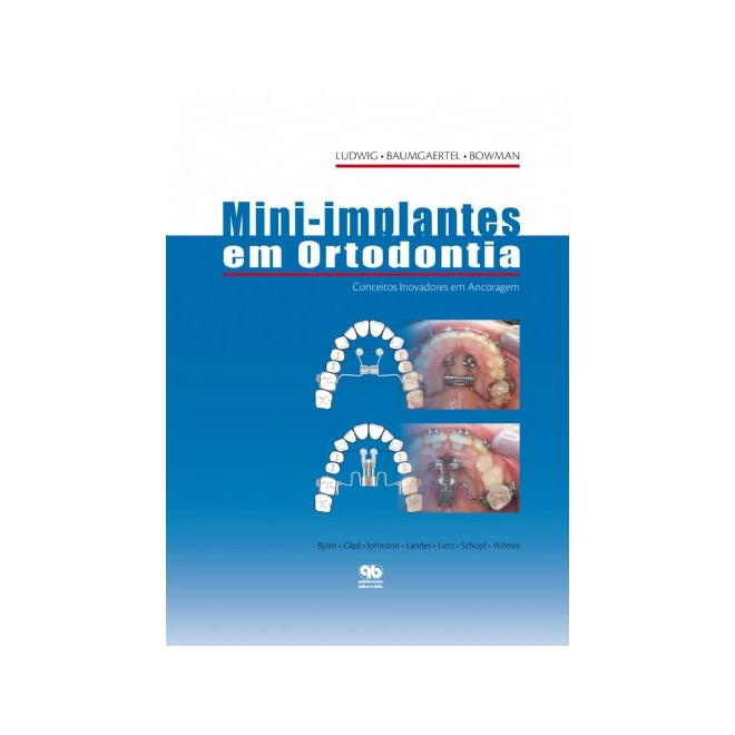Livro - Mini-Implantes em Ortodontia - Ludwig - Santos