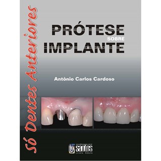 Livro - Prótese sobre Implante: Só Dentes Anteriores - Cardoso