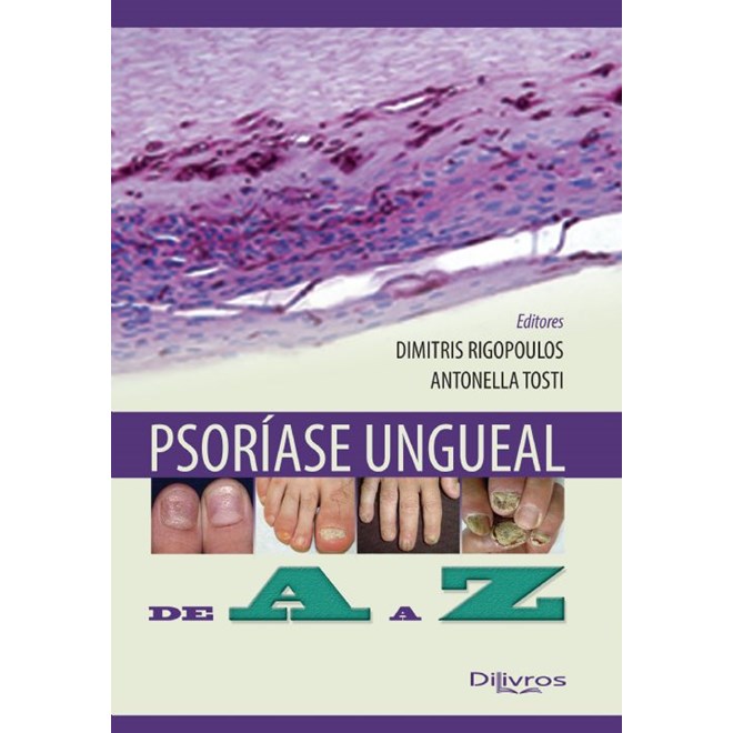 Livro - Psoriase Ungueal de a a Z - Rigopoulos/tosti