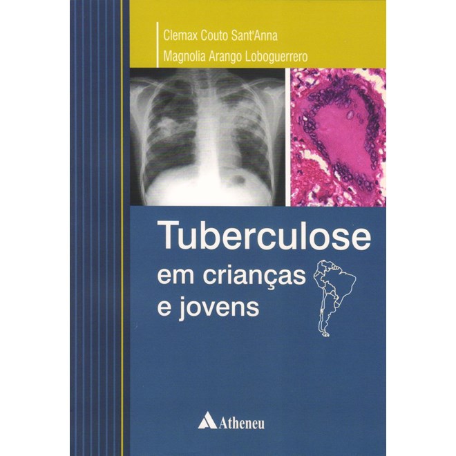Livro - Tuberculose em Criancas e Jovens - Santanna/loboguerrer
