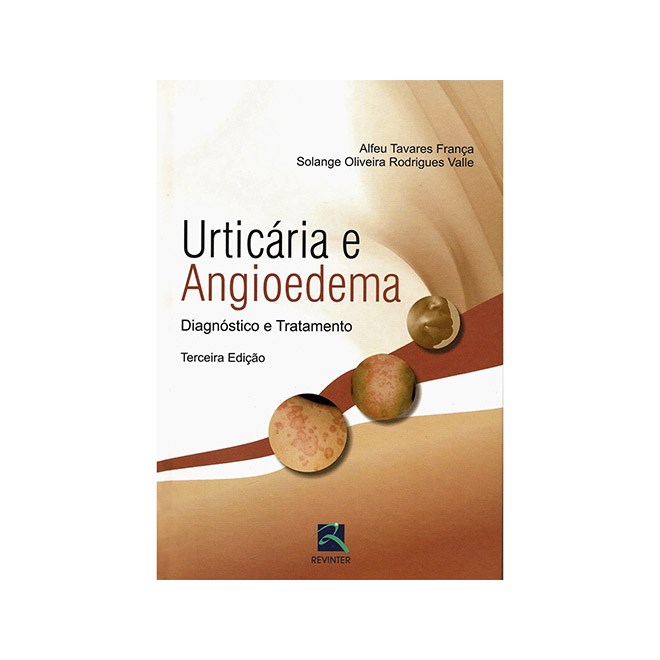 Livro - Urticaria e Angioedema - Diagnostico e Tratamento - Franca/valle