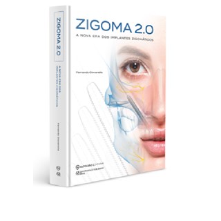 Livro - Zigoma 2.0: a Nova era dos Implantes Zigomaticos - Giovanella
